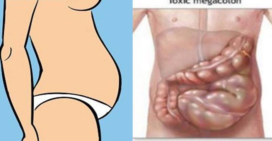 you-are-not-fat-your-stomach-is-bloated-here-is-how-to-get-rid-of-it